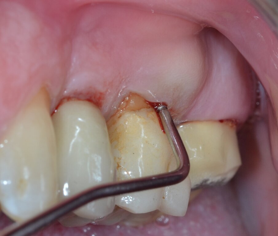 Fig. 1 - Immagine clinica preoperatoria: si evidenzia il coinvolgimento della forcazione radicolare buccale associato a una raccolta purulenta.