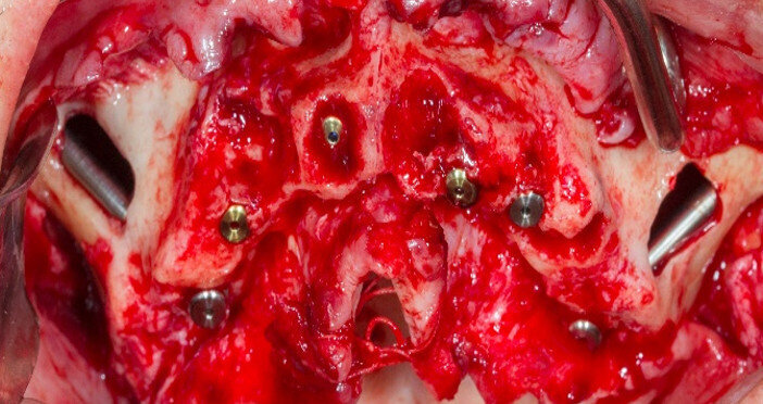Fig. 8: Intra-op aspect of implant placement.