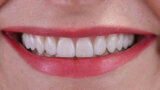 Fig. 17d. Amplia sonrisa.