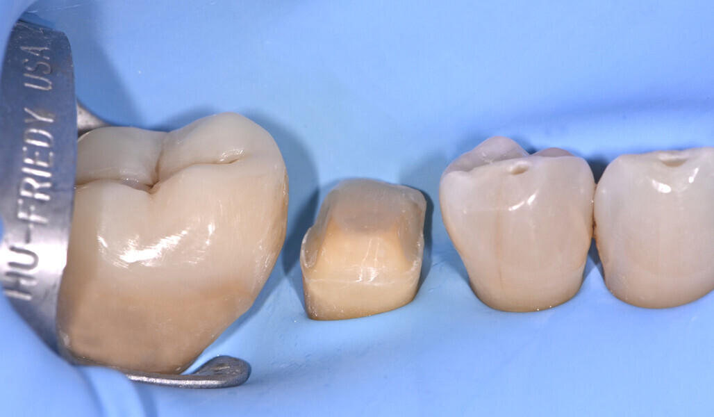 Fig. 10: Sealed tooth preparation ready for impression taking. 