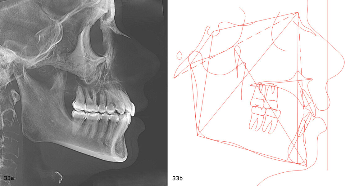 Figs. 33a & b: Post-treatment cephalometric radiograph (a) and tracing (b).