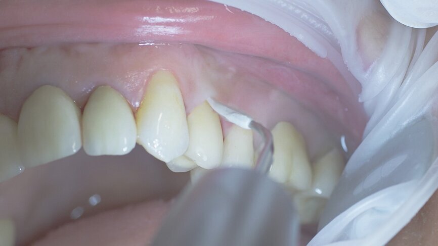 Fig. 5: Implants and suprastructures are routinely cleaned, for example using ultrasound devices and special plastic instruments (W&H Tigon (+) with 1I tip). (Photograph: W&H)
