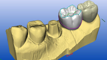 Safety-first implant therapy