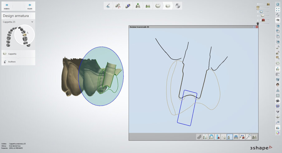 Fig. 7 - L’odontotecnico è così in grado di eseguire una valutazione attenta sulla posizione implantare, sulla possibilità di realizzare una protesi avvitata, sui margini estetici, sulla componentistica protesica da impiegare. Il disegno della corona in sezione permette un’ampia valutazione.