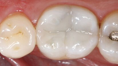 Nano-hybrid ORMOCER  for the bulk-fill technique in the posterior region