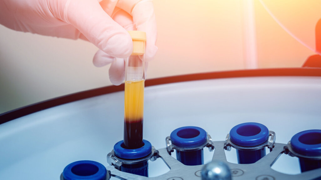 Best for osseointegration: Second-generation vs third-generation autologous blood products