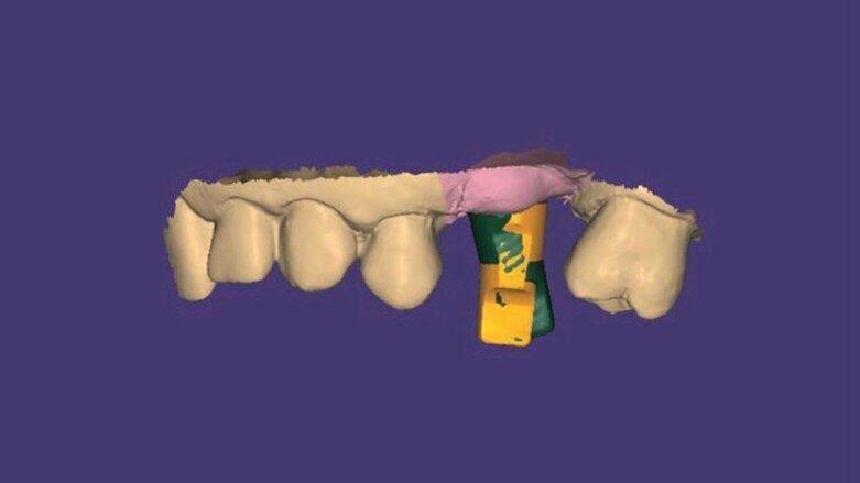 Il workflow digitale REX PiezoImplant nelle creste sottili