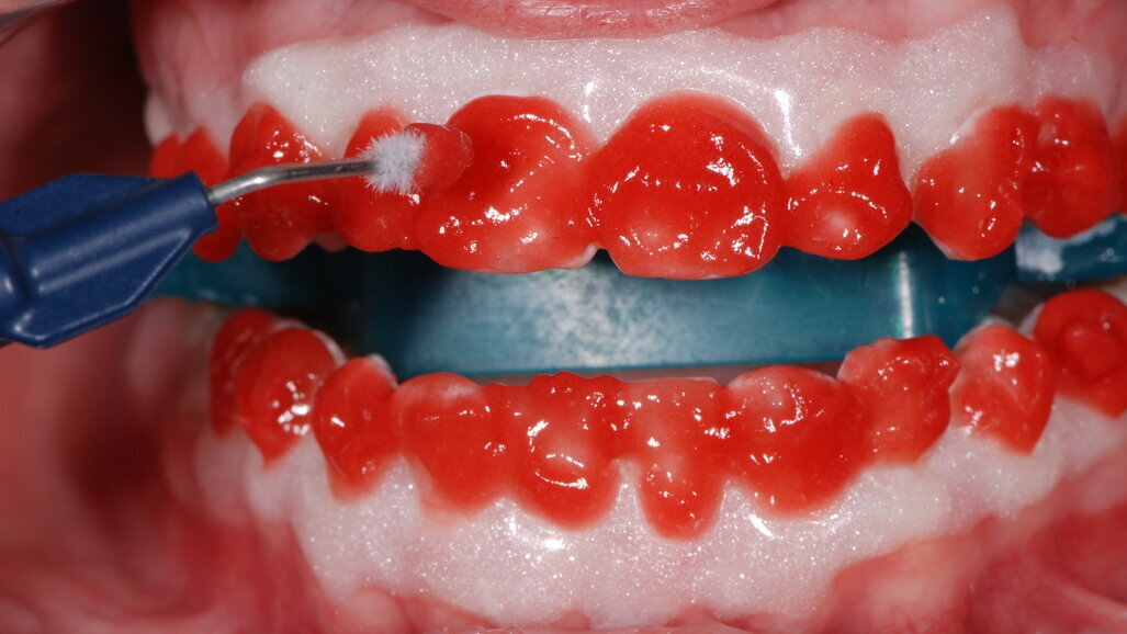 Los pros y los contras de los aclaramientos dentales
