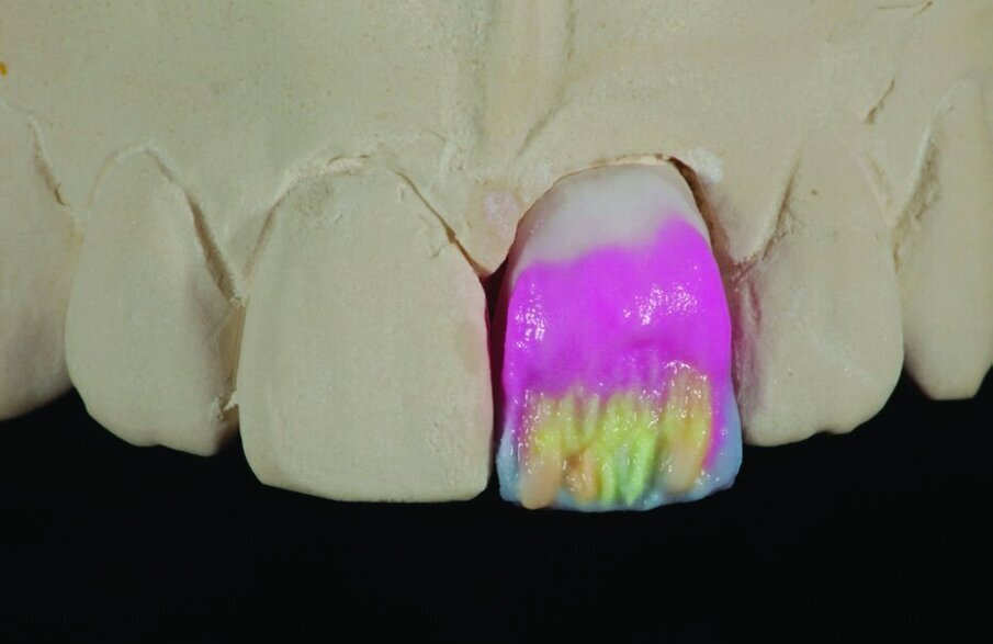 Figs 4, 5, 6 and 7: The versatile range of IPS e.max Ceram materials allows you to imitate bleached tooth shades showing lifelike light reflection.
