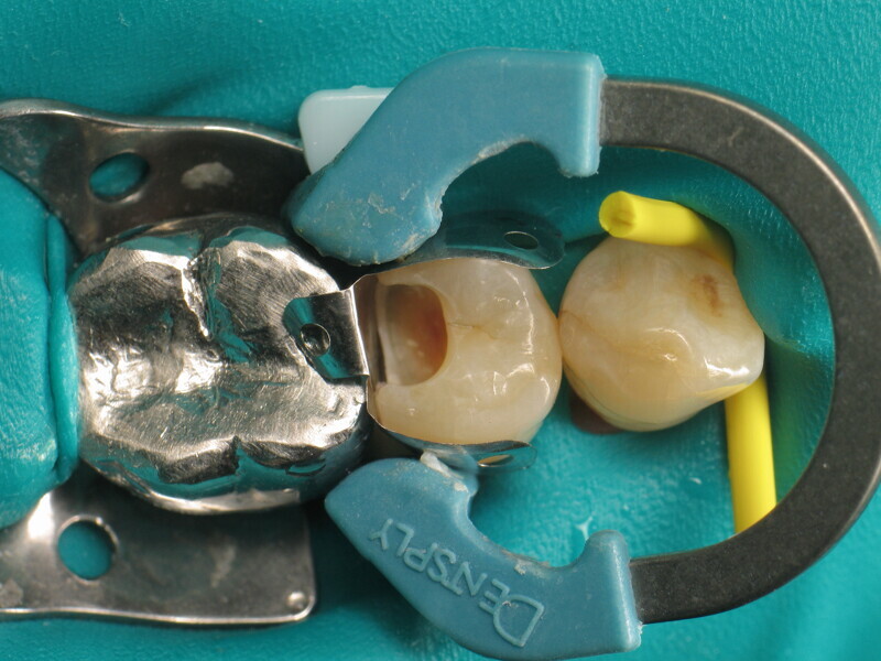 Fig. 6 : Cavité après rinçage et séchage.