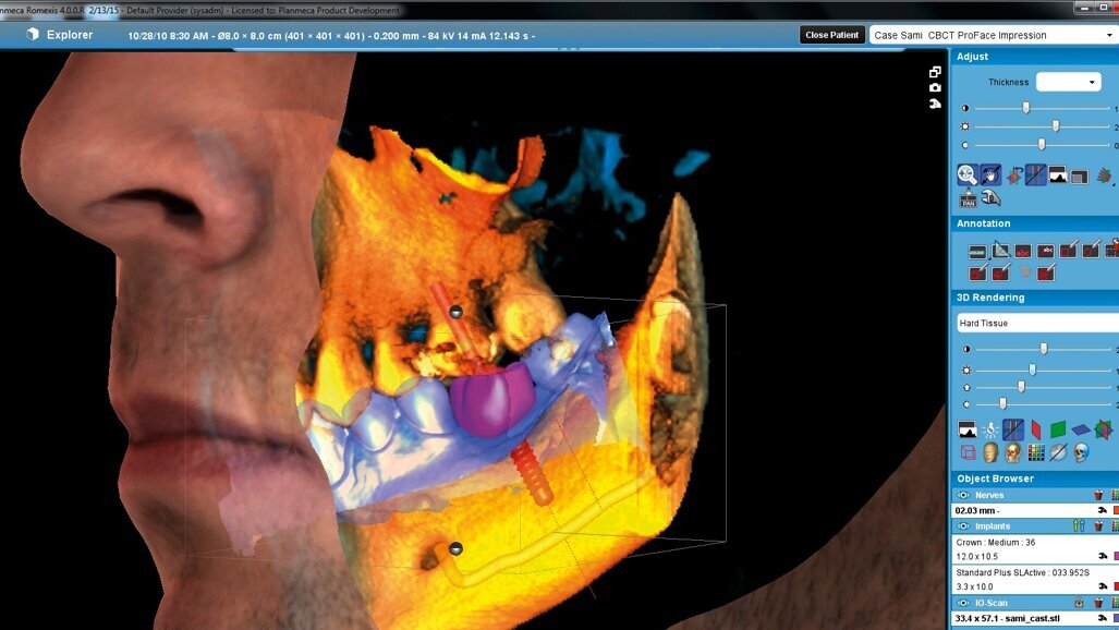 Planmeca Romexis®－CAD/CAM 工作与CBCT 数据处理均可在同一软件上完成