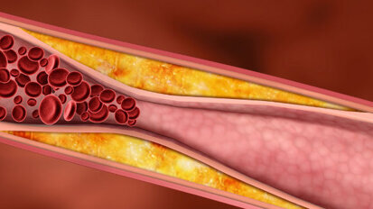 Dental plaque bacteria may trigger endocarditis