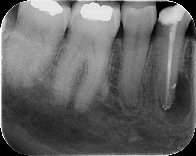 Fig. 9: Post-op radiograph.