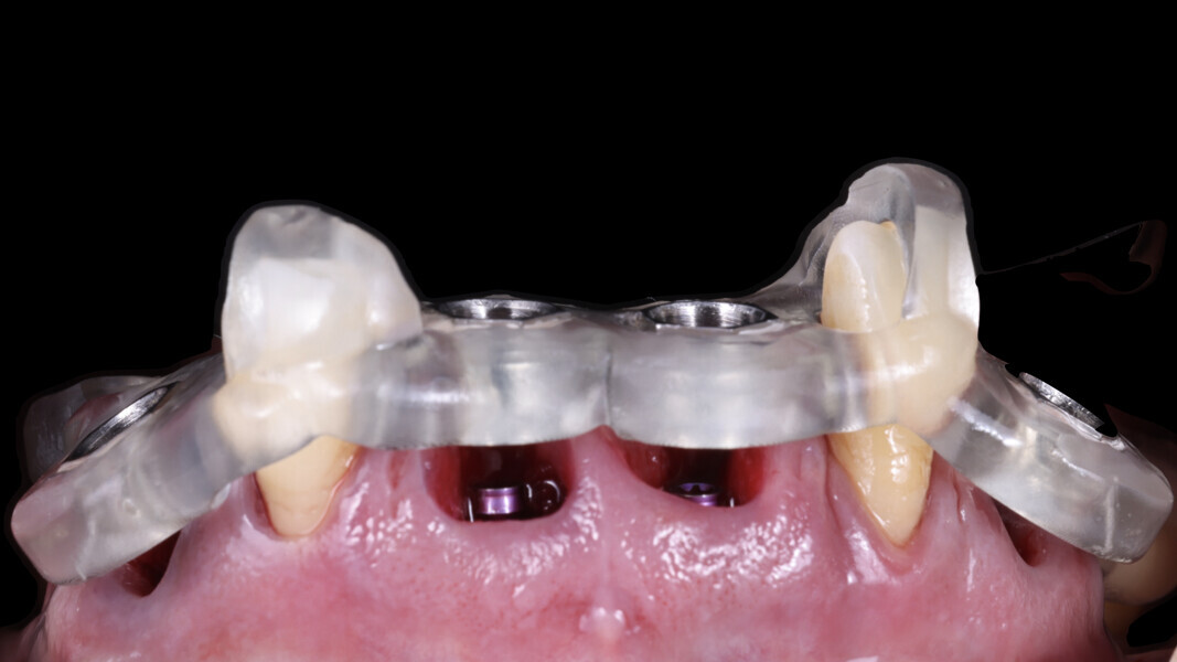 Fig. 17: Verified guide and implants in position.