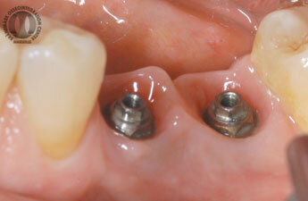 Papilla creation between two implants