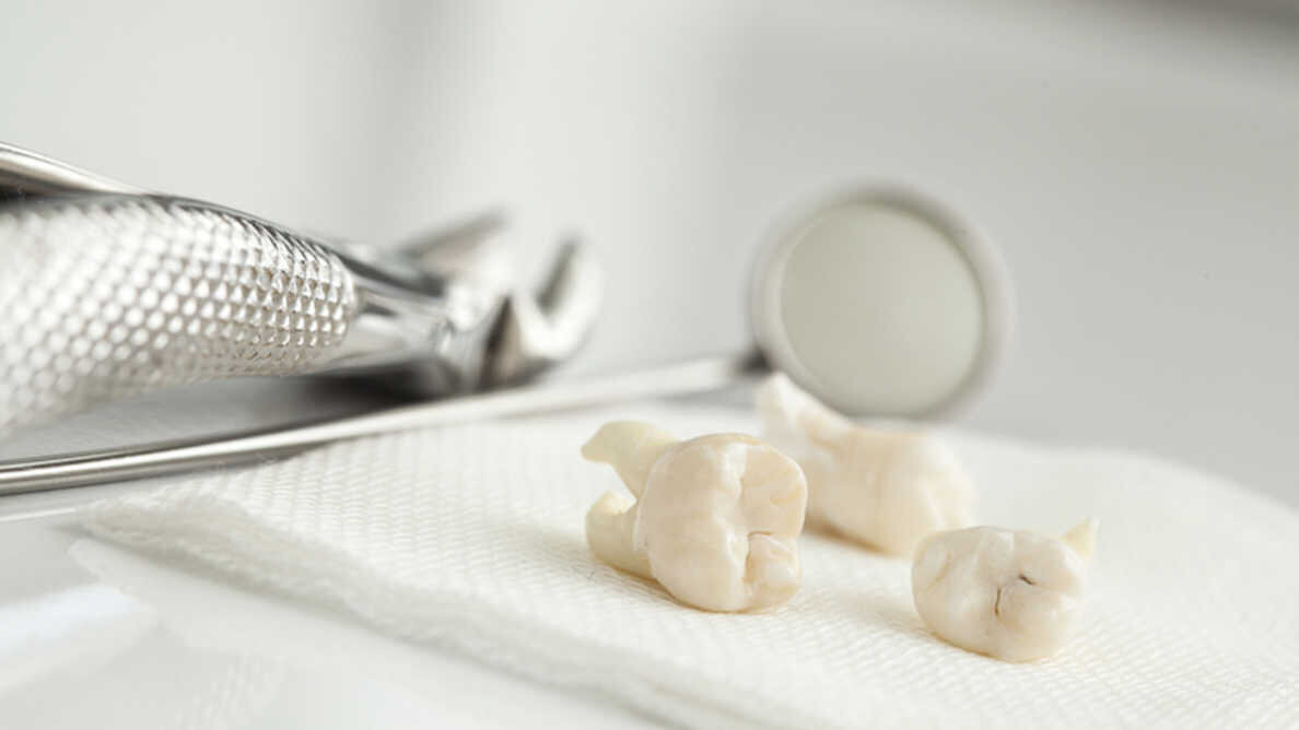 En Inde, un chirurgien-dentiste extrait 526 dents de la bouche d’un enfant