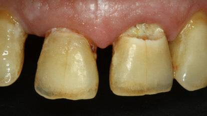 Cambio de paradigma en la remoción de caries