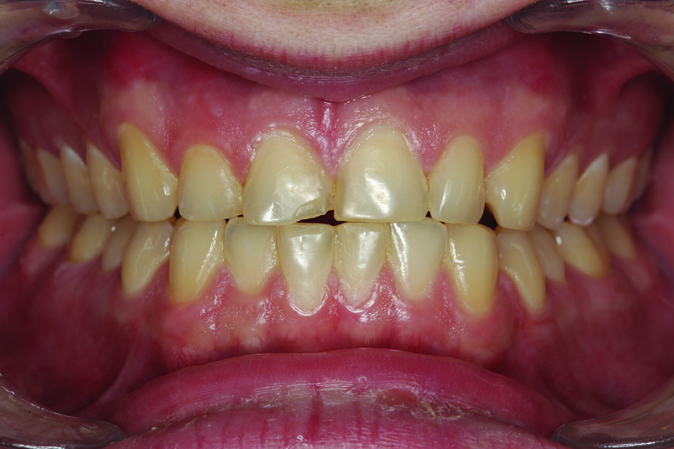 Fig. 2: Teeth in protrusive excursion, showing excessive wear on the tooth (# 41) opposing tooth #11, indicating hyperfunction and increased functional stress on the restored area.