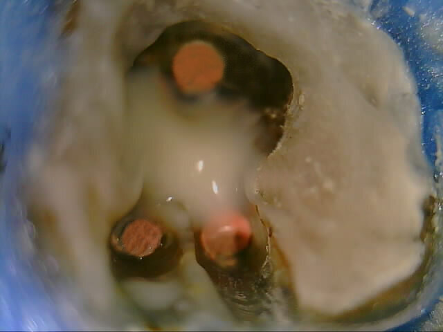 Fig. 6: Drilling region protection sealed with glass ionomer cement.