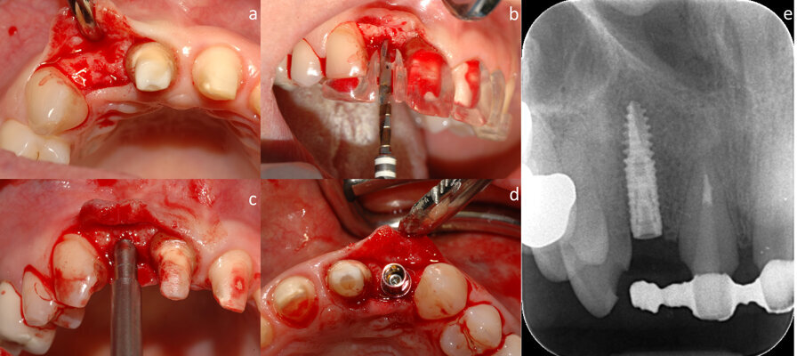 Fig. 2 - Incisione a spessore totale e sollevamento di un lembo a busta (a), inserimento dell’impianto in corrispondenza dell’elemento dentale mancante con l’aiuto di una guida chirurgica (b, c, d), aspetto radiografico dell’impianto (e).