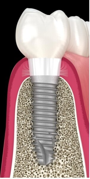 Fig. 9 : Implant hybride (TBR dental implant Z1 infinity) alliant l’avantage des propriétés biomécanique du titane et les propriétés biologiques de la zircone, notamment dans la zone cervicale pour protéger le corps de l’implant des attaques bio-corrosives du milieu buccal.