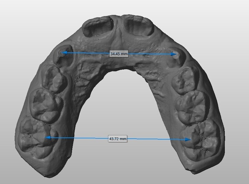 Fig. 12a: Maxillary arch size analysis at the (a) start and (b) end of treatment.