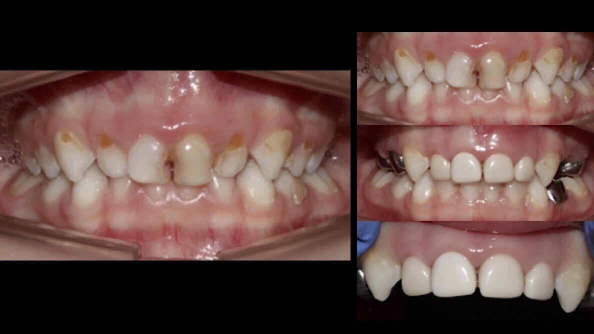 Caries severa de primera infancia en odontopediatría