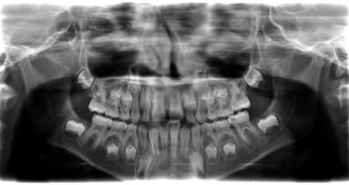 Le futur de l’endodontie : la revascularisation pulpaire