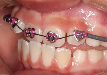 WildSmiles braces