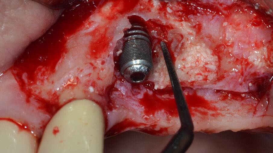 Fig. 5 - Debridement del tessuto di granulazione e dei residui di biomateriale mediante inserto a ultrasuoni.