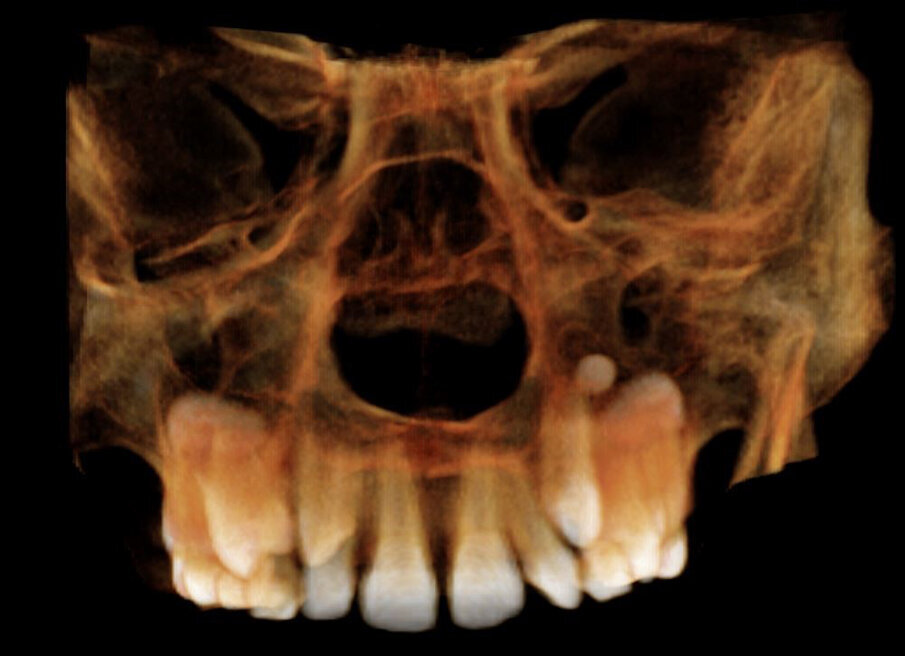 Fig. 21_CBCT mascellare superiore.