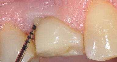 Peri-implantitis: from the diagnosis to the treatment