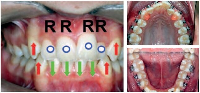 U & L Initial Bonding:  U & L 014 CN - Anterior Bite Turbos
