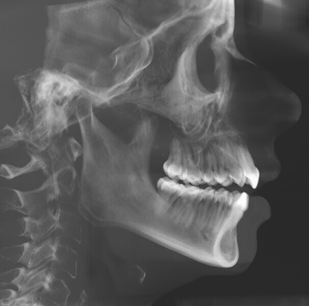 Fig. 25: Cephalometric radiograph after splint therapy (increased overjet).