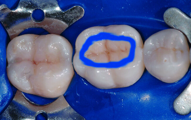 Fig. 33 : Après mise en place de la digue, un gel d’acide orthophosphorique à 35 % est place pendant 30 secondes au niveau du joint dent/restauration.