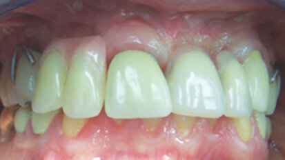 Implant fracture: A look at the physical mechanisms for failure