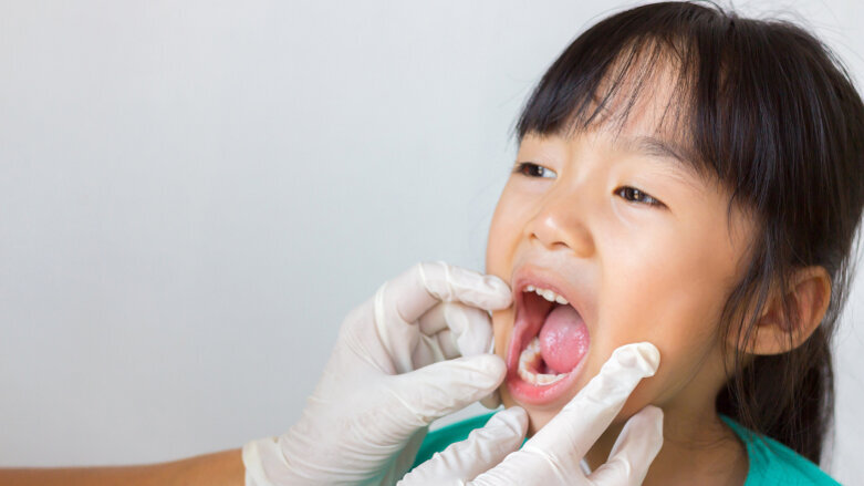 Sealed primary molars reduce caries risk