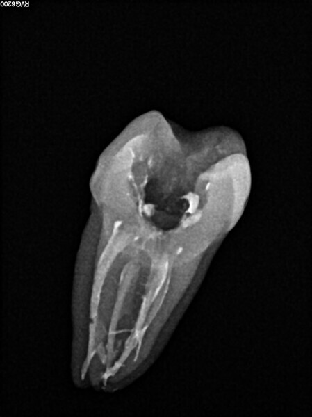 Fig. 3: Post-op radiograph of a mandibular molar.
