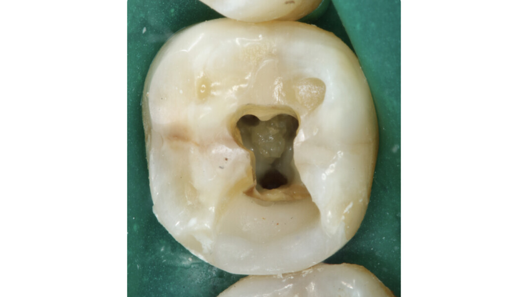 Fig. 16 : Phase intermédiaire du traitement : préparation de la cavité d’accès et mise en forme préliminaire des canaux radiculaires après la reconstruction préendodontique. Il faut noter la présence d’une calcification pulpaire d’aspect translucide sur le plancher de la cavité.