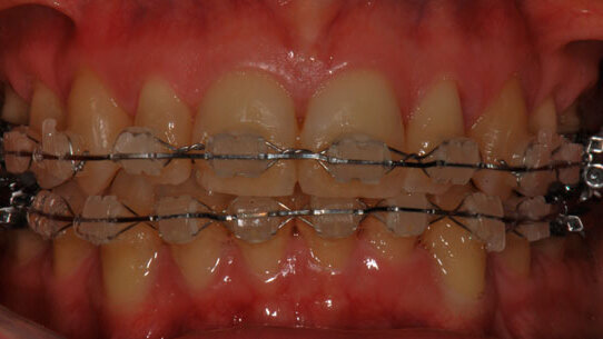 Case Report sulla riabiltazione protesica