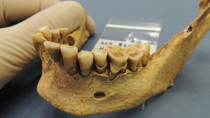 Ancient teeth bacteria track disease evolution