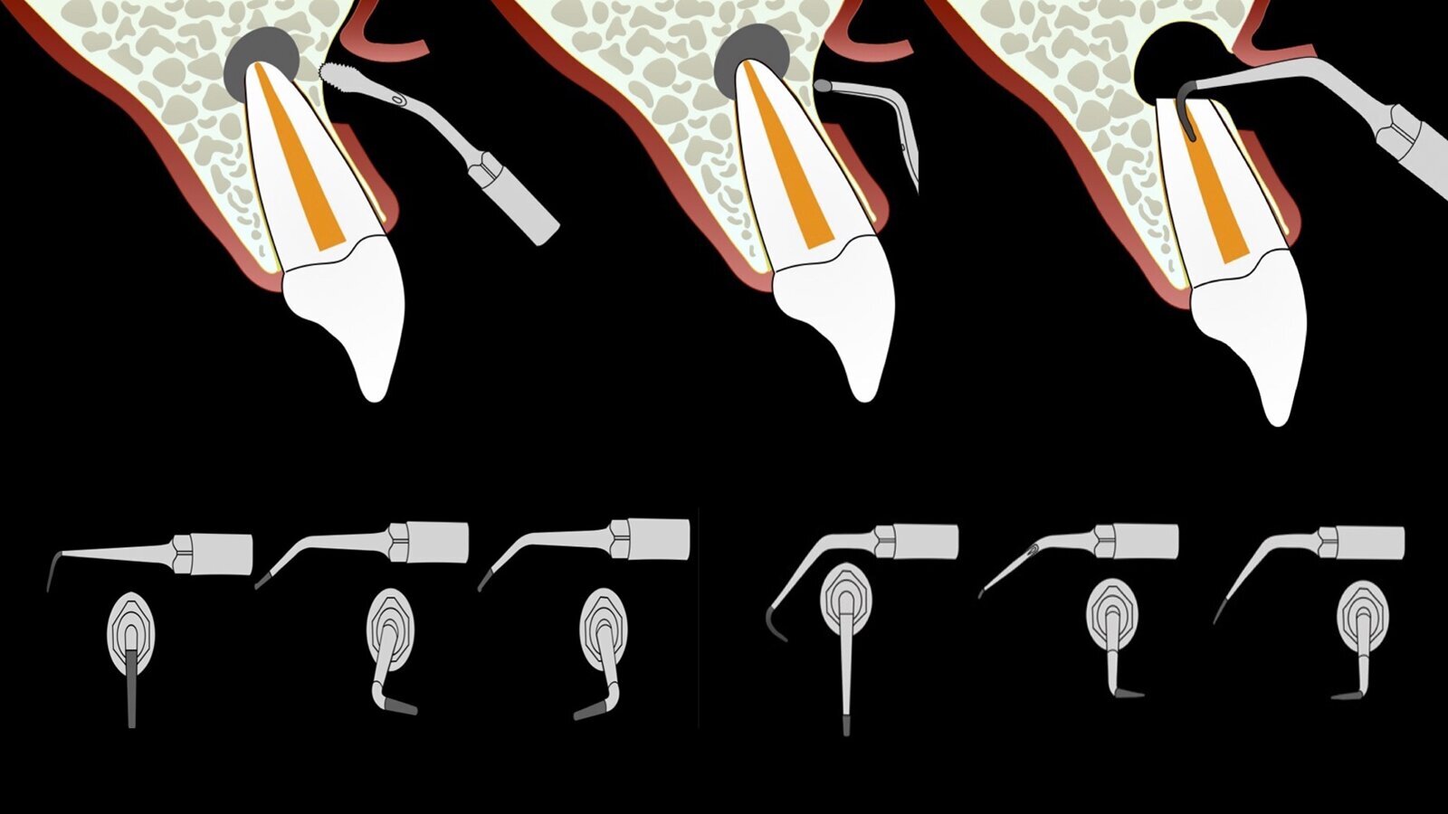      Piezocirugía  5    El éxito de la cirugía apical en endodoncia