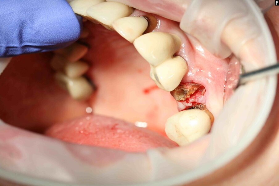 Fig. 6: The crown was fractured during luxation.