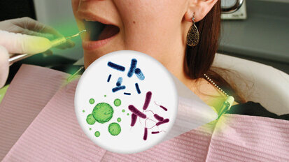 Unsterilized bib chains may cause crosscontamination