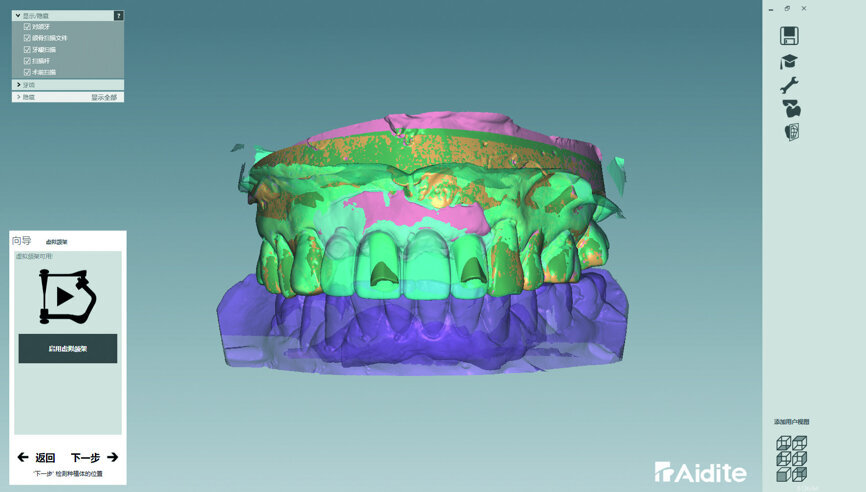 Fig. 35: The provisional digital model was matched with the cast digital model.