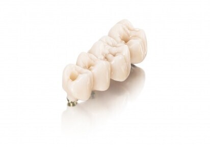 Nobel Biocare – NobelProcera Implant Bridge