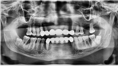 Treatment of patients with severe periodontal disease in general dental practice