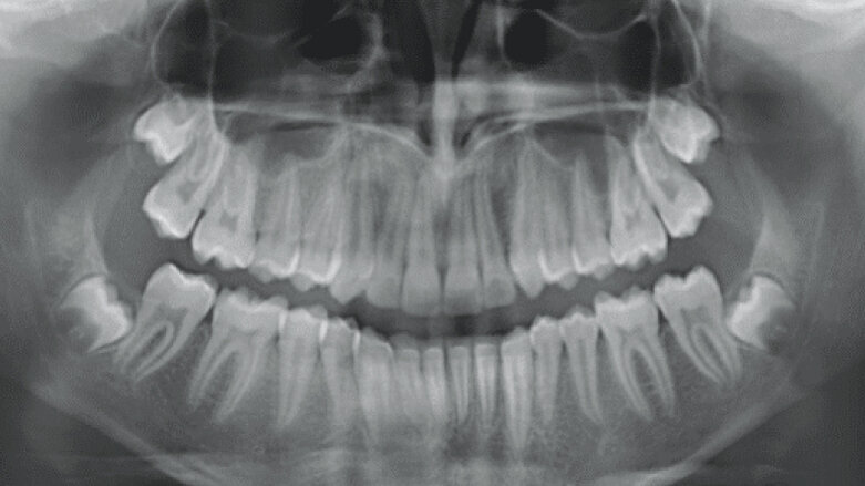 Treatment of Class II division 1 malocclusion treatment with mandibular advancement features