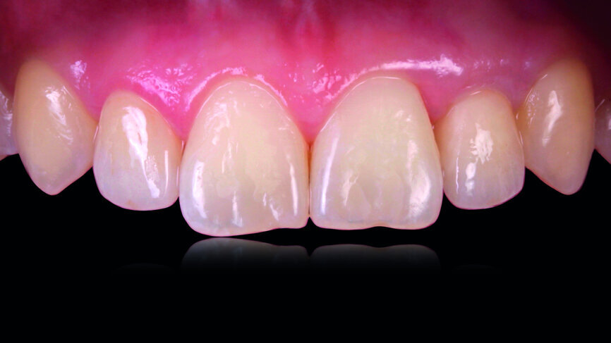 Fig. 24: Final outcome after the completion of the treatment.