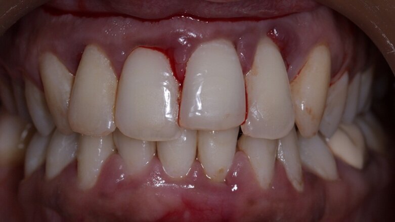 Recent study in Japan finds a possible link between bruxism and periodontal disease